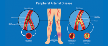 Aneurysm Treatment